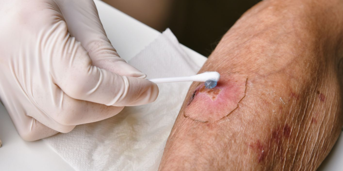 Bild zum Kurs 09.06.2026 | Palliative Wundbehandlung | Copyright: canva-gettyimages